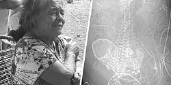 В Бразилии в утробе 84-летней женщины обнаружили окаменелый плод