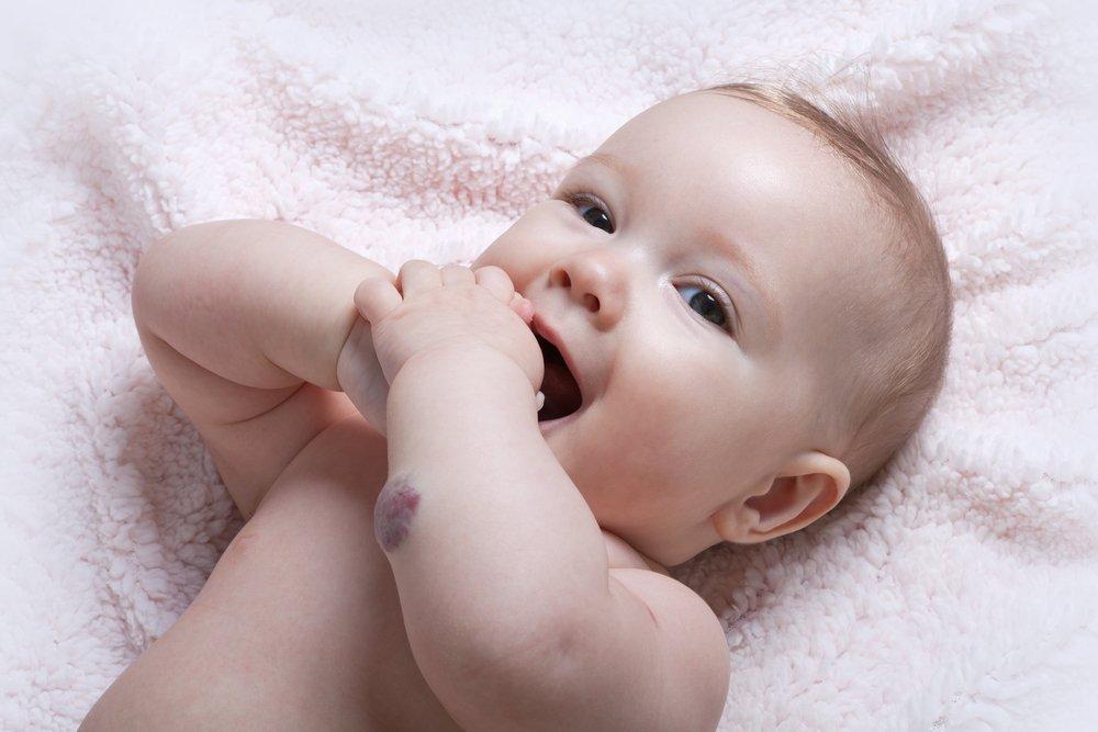 Гемангиомы у новорожденных детей: причины  и лечение