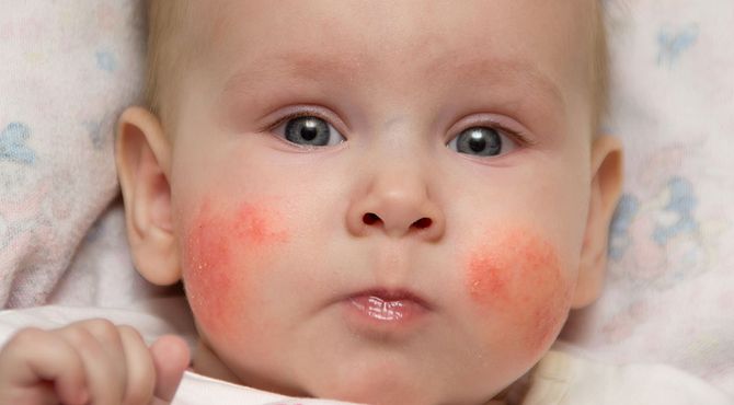 Как выглядит диатез у новорожденных на лице фото лечение